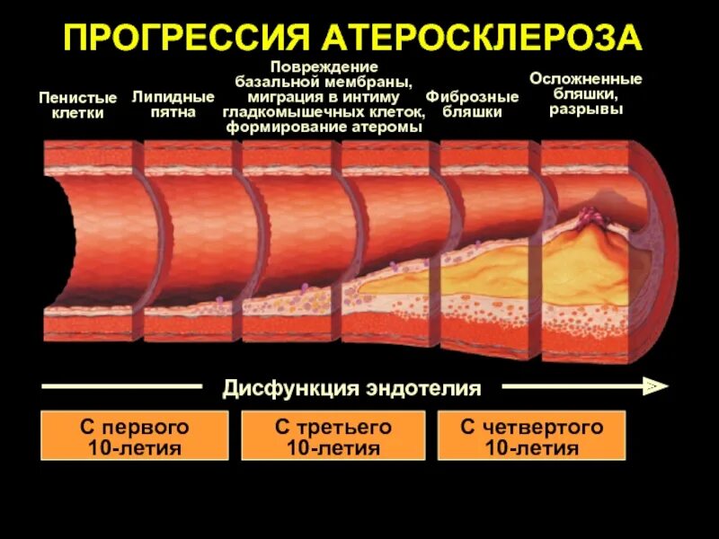 Механизм развития атеросклероза сосудов. Патогенез атеросклероза повреждение эндотелия. Стадии развития атеросклеротической бляшки. Этапы формирования атеросклеротической бляшки. Изменение сосудистой стенки