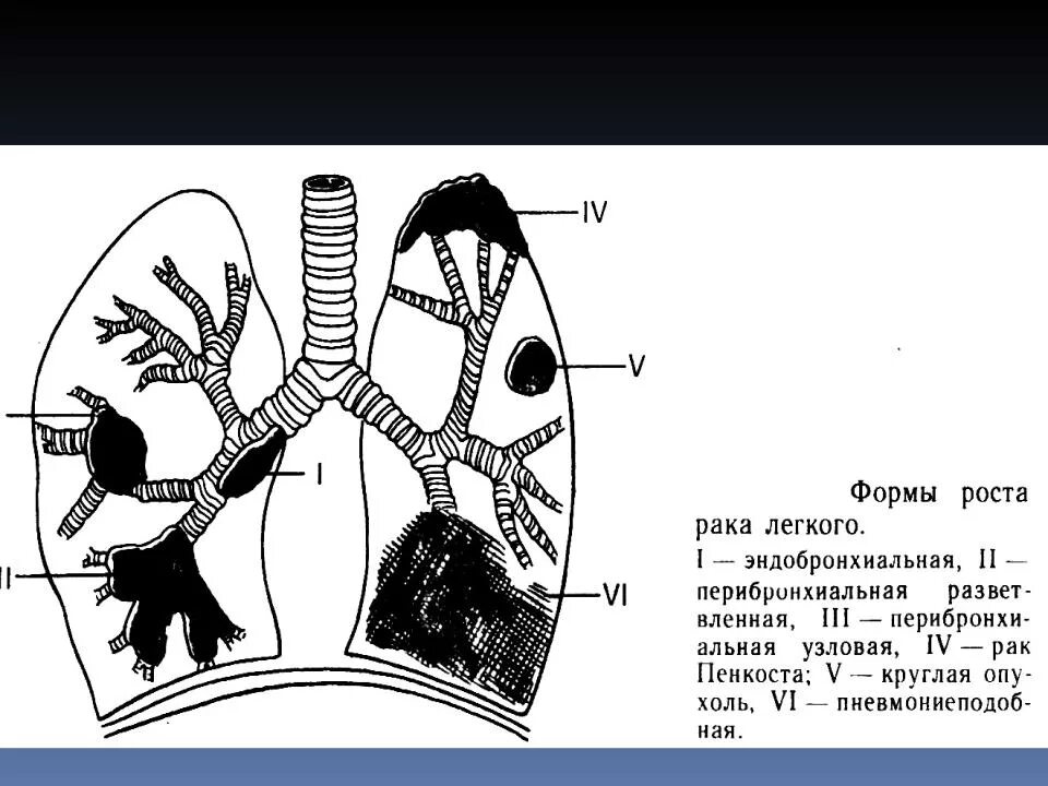 Стадии рака бронха. Центральная опухоль легкого. Периферические опухоли легких. Опухоли легких классификация.