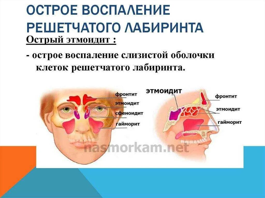 Что такое этмоидит в носовой пазухе ?. Хронический гайморит этмоидит фронтит. Синусит решетчатой пазухи симптомы. Хронический Гнойный этмоидит.