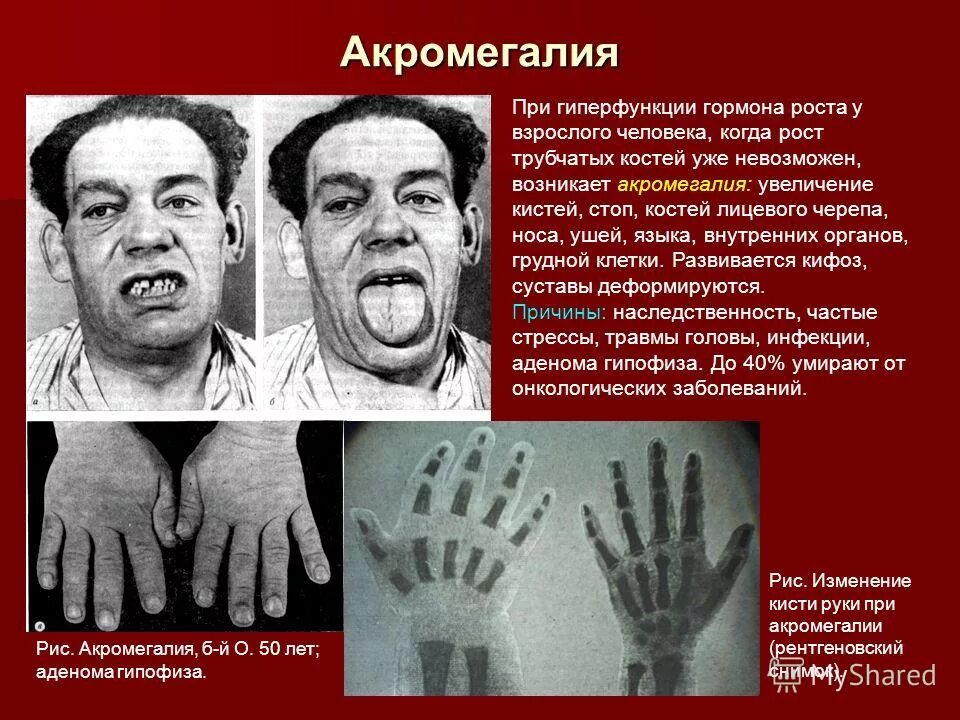 зона роста трубчатых костей. гигантизм этиология и патогенез. тироксин функции в организме. ускоренный рост костей. рост костей.