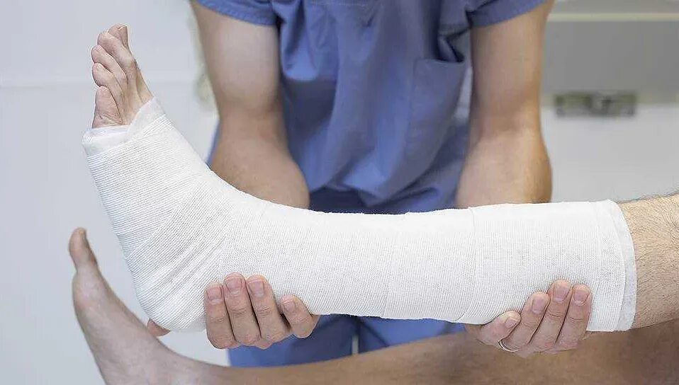 Гипс при вывихе. Гипсовая повязка перелом лодыжки. циркуляторные гипсовые повязки. циркулярная гипсовая повязка.