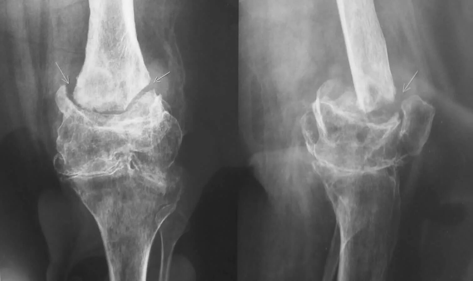 неоартроз тазобедренного сустава. хронический остеомиелит большеберцовой кости рентген. ложный сустав при переломе ключицы. врожденный ложный сустав на рентгене. ложный сустав ключицы рентген.