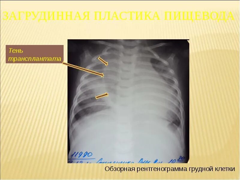 Загрудинная пластика пищевода. Атрезия пищевода презентация. Атрезия пищевода рентген. Ретростернальная пластика пищевода. Презентация пищевода