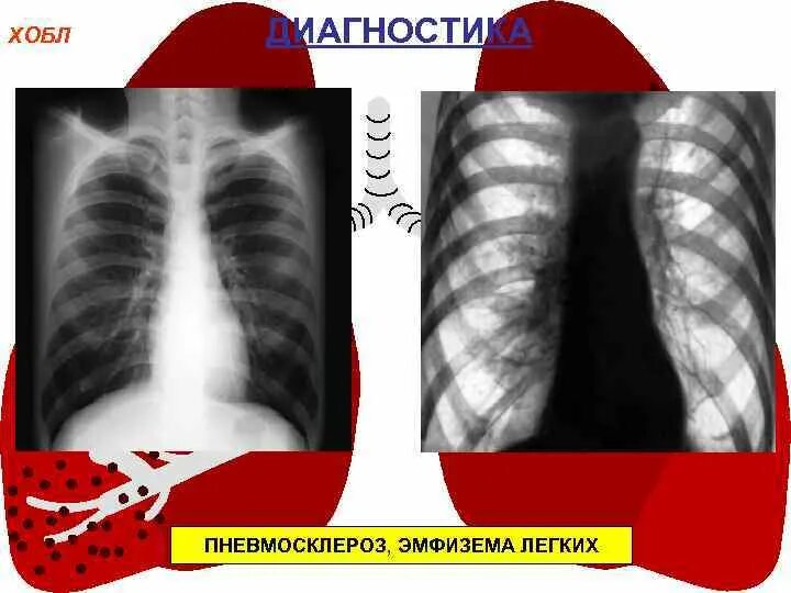 Перибронхитический пневмосклероз. Эмфизема на рентгенограмме. Эмфизема пневмосклероз. Эмфизема,диффузный пневмосклероз. Как лечить диффузный пневмосклероз легких