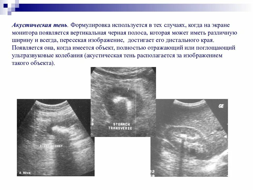 Акустические тени в почках. Акустическая тень на УЗИ. Дистальная акустическая тень на УЗИ. Акустическая дорожка на УЗИ. Гиперэхогенное образование с акустической тенью.