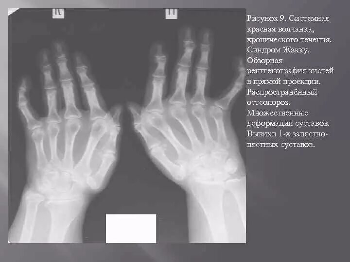 Поражение суставов при системной красной волчанке. Рентген суставов при СКВ. Системная красная волчанка рентген кистей. Деформирующий ревматоидный артрит. Красная волчанка ревматоидный артрит