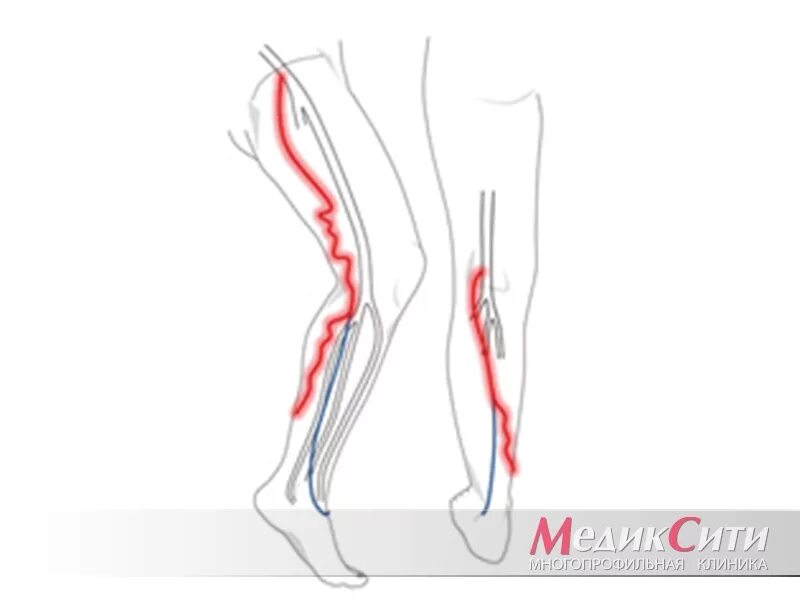 Боли ногах вены тянет. Тромбоэмболия сосудов нижних конечностей.