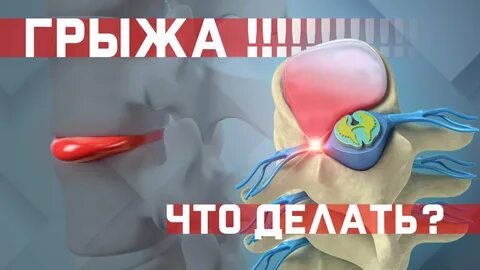 Как лечить межпозвоночную грыжу? Как жить с грыжей? Что с ней делать? - смотреть