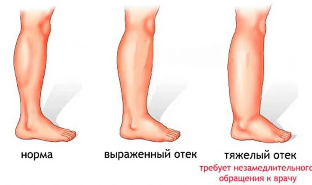Сколько времени длится отек. Отечность нижних конечностей. отеки нижнихонечносте.