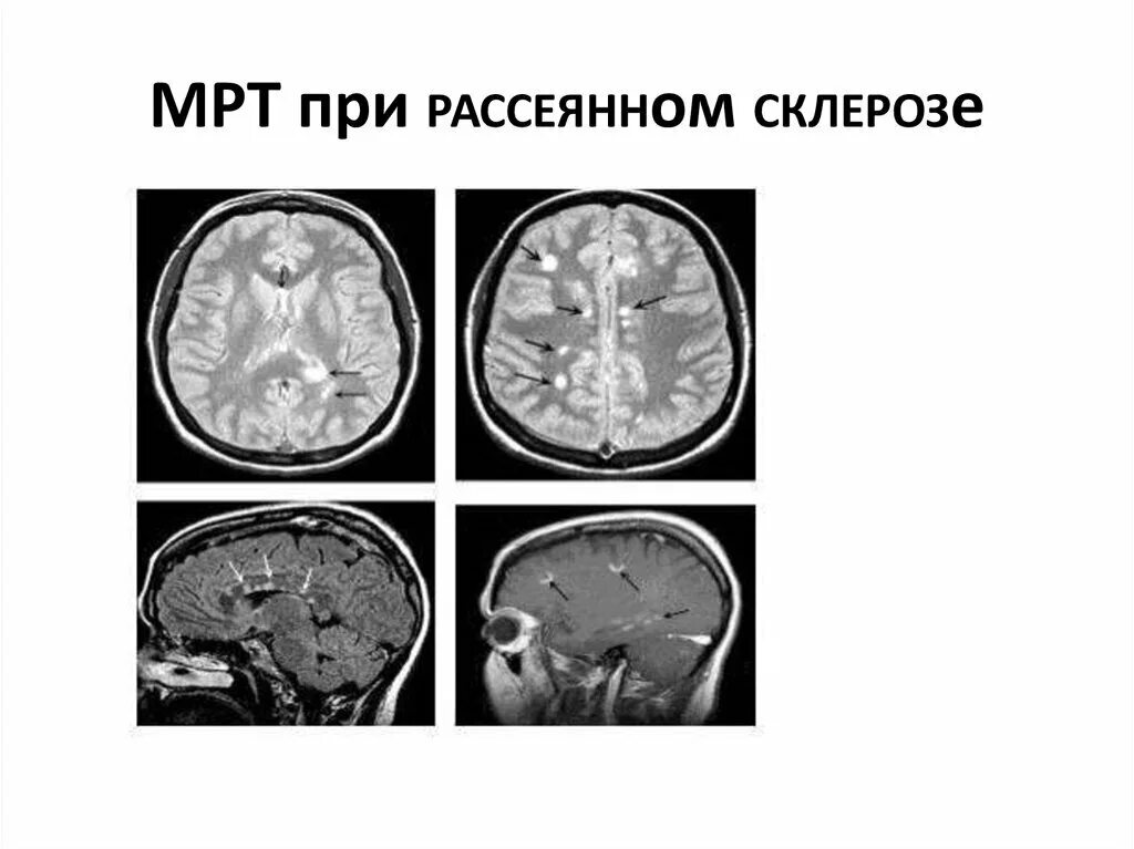 Склероз мозга. Рассеянный склероз на мрт головного мозга. Рассеянный склероз мрт картина. Рассеянный склероз мозжечковая форма. Мрт рассеянного склероза.