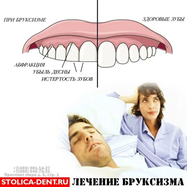 Бруксизм у взрослых психосоматика. Скрежет зубами по ночам. Почему спящий скрипит зубами