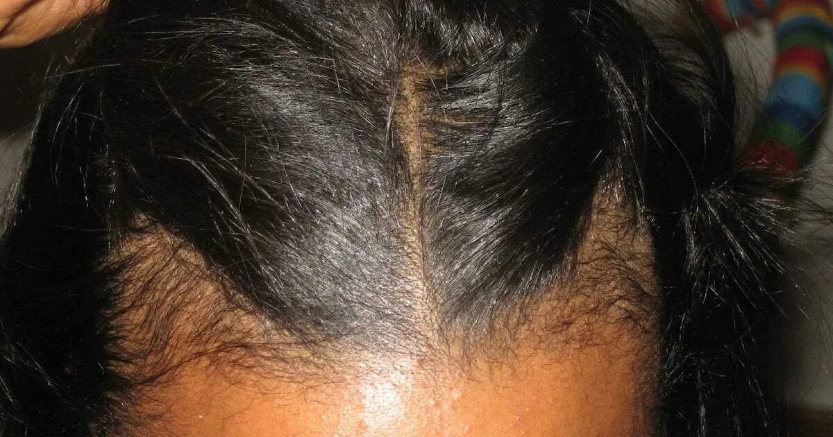Кормящих выпадают волосы. Сильное выпадение волос. Послеродовая алопеция. Послеродовое выпадение волос.