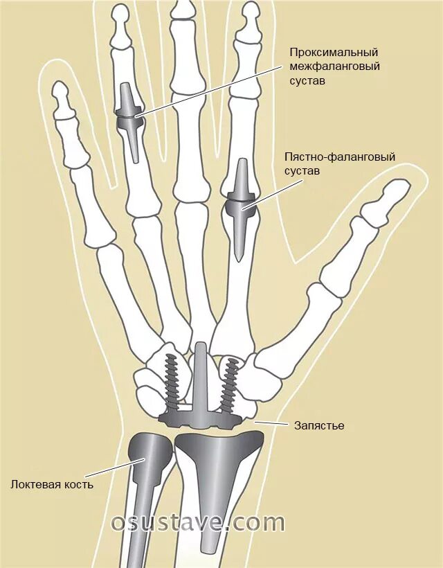 Остеосинтез 1 пястной кости кисти. Эндопротезирование лучезапястного сустава. Проксимальный пястно фаланговый сустав. Эндопротез пястно-фалангового сустава. Пластина в пальце