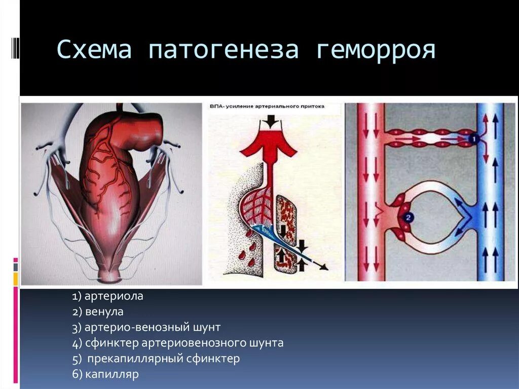 Этиопатогенез геморроя. Патогенез геморроидальной болезни. Малоинвазивное лечение геморроя