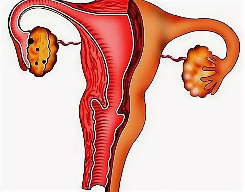 Вагинит бактериальный вагинит. Подострый кольповагинит. Атрофический вагинит у женщин лечение