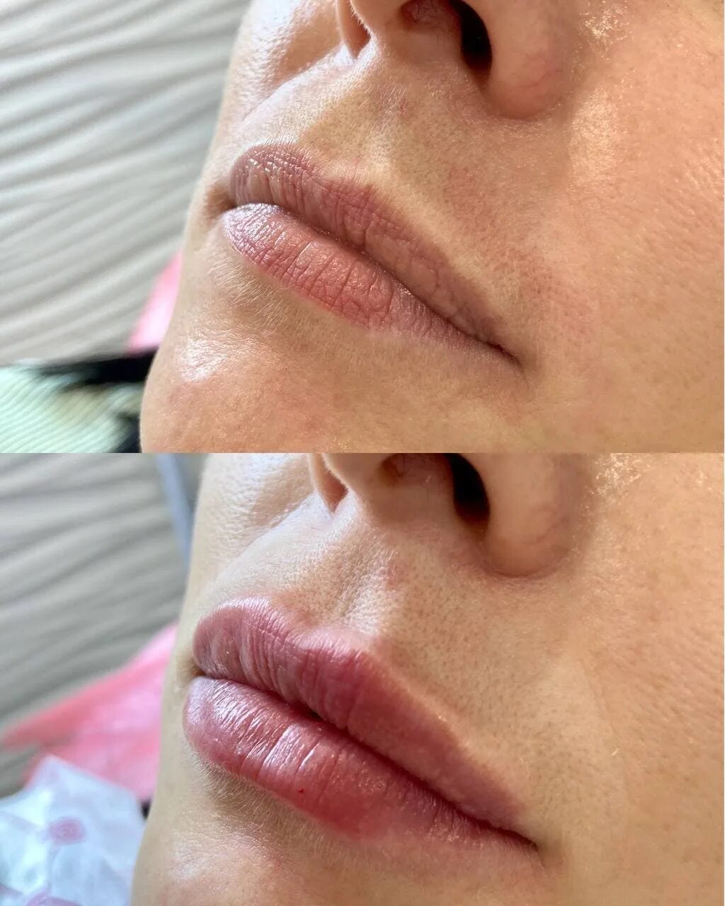 6. Красивое увеличение губ. 6. Губы 0. Губы 0 6 мл гиалуроновой кислотой.