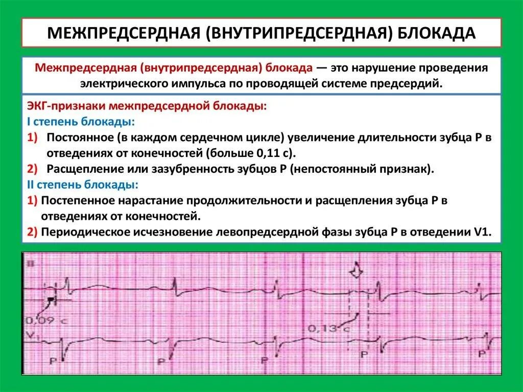 Экг метаболические изменения что это значит. Внутрипредсердная блокада 2 степени на ЭКГ. ЭКГ критерии нарушения проводимости. Av блокада 2 степени кардиограмма. Внутрипредсердная блокада 3 степени ЭКГ.