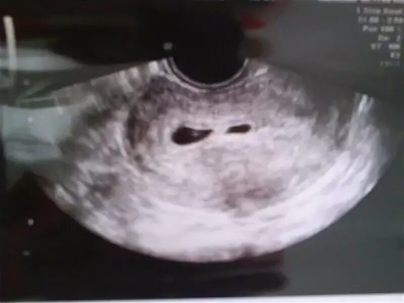 Двойня 5 недель беременности. УЗИ беременность 2 плодных яйца. УЗИ беременности двойней на 6 неделе беременности. УЗИ на 4 неделе беременности двойня.