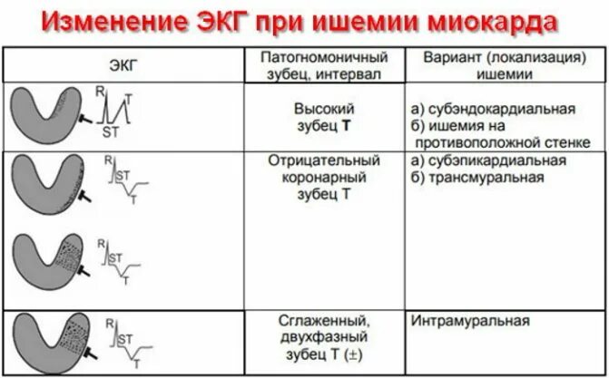 Диффузные повреждения миокарда. Экг при ишемических изменениях миокарда. изменения на экг при ишемии задней стенки. признаки ишемии миокарда на экг. форма желудочкового комплекса при интрамуральной ишемии миокарда.