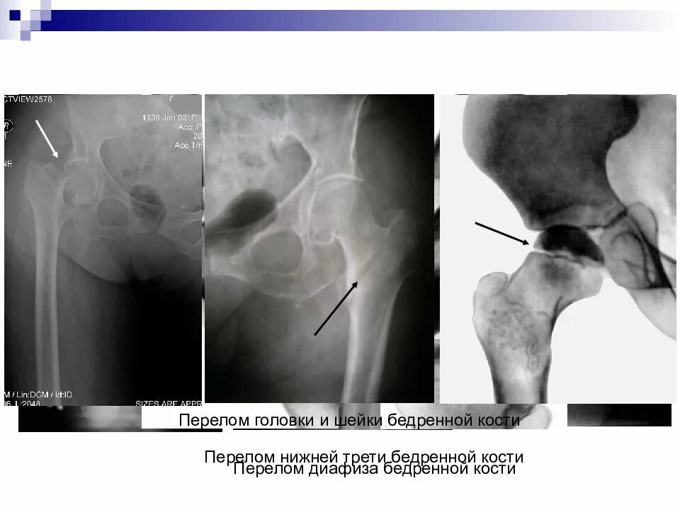 Импрессионный перелом шейки бедренной кости кт. Субкапитальный перелом головки бедренной кости. Вколоченный перелом шейки бедра рентген. Аддукционный перелом шейки бедра рентген. Трещина шейки