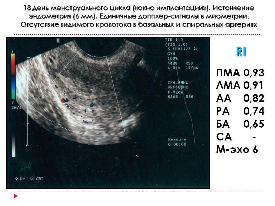 Какой эндометрий при месячных. Эндометрий матки 10мм. Эндометрий толщина 12мм это. Эндометрий на 5 день цикла по УЗИ. Эндометрий 9 мм на 11 день цикла.