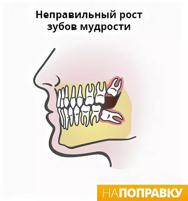 Неправильный рост зубов мудрости. Неправильный рост зубов. Челюсть человека с зубами мудрости.