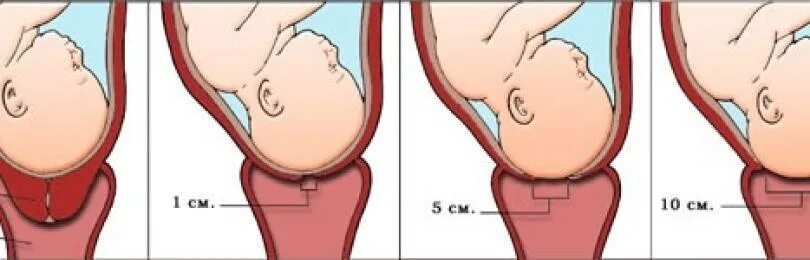 Почему раскрывается матка. Короткая шейка матки при беременности 32 недели. Короткая шейка матки 2 см. Период раскрытия шейки матки.