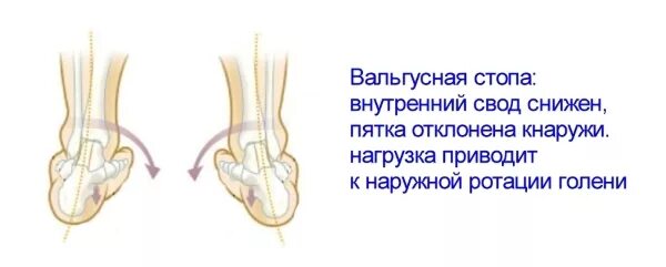 Вальгусная стопа у ребенка код мкб. Массаж стопы при вальгусной деформации стопы у детей. вальгусная деформация стоп у новорожденного. массаж для стоп при вальгусной деформации стопы у детей. варусная стопа рентген.