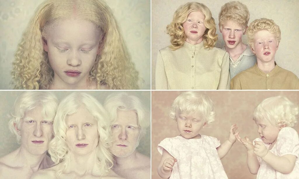 Наследственная болезнь альбинизм. Наследственная изменчивость альбинизм. Генетические заболевания альбинизм.
