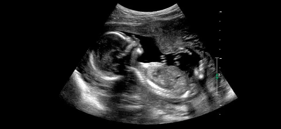 Ребенок на 18 неделе беременности. УЗИ плода на 18 неделе беременности. Снимок УЗИ на 18 неделе беременности. Ребёнок на 18 неделе беременности УЗИ. 18 Недель беременности фото плода на УЗИ.