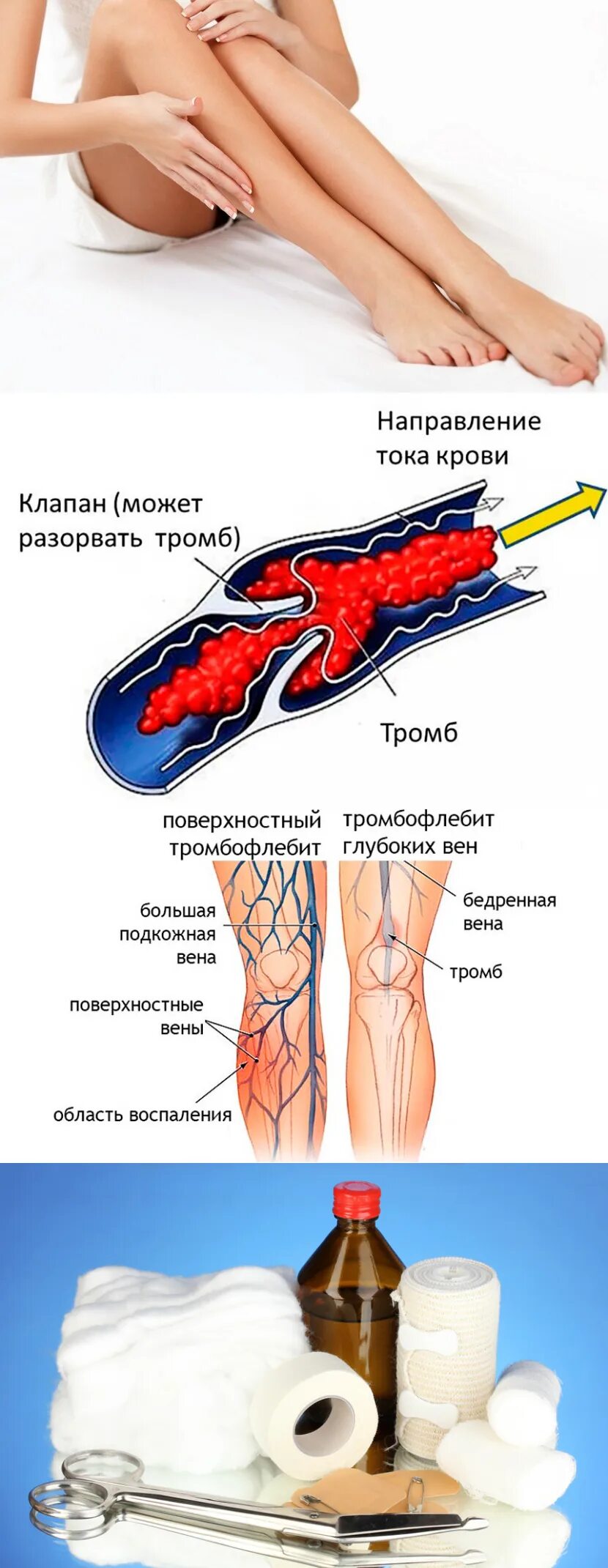 Тромбофлебит нижних конечностей. Тромбофлебит поверхностных вен нижних конечностей. Тромбоз нижних конечностей. Флеботромбоз нижних конечностей. Препараты при тромбофлебите