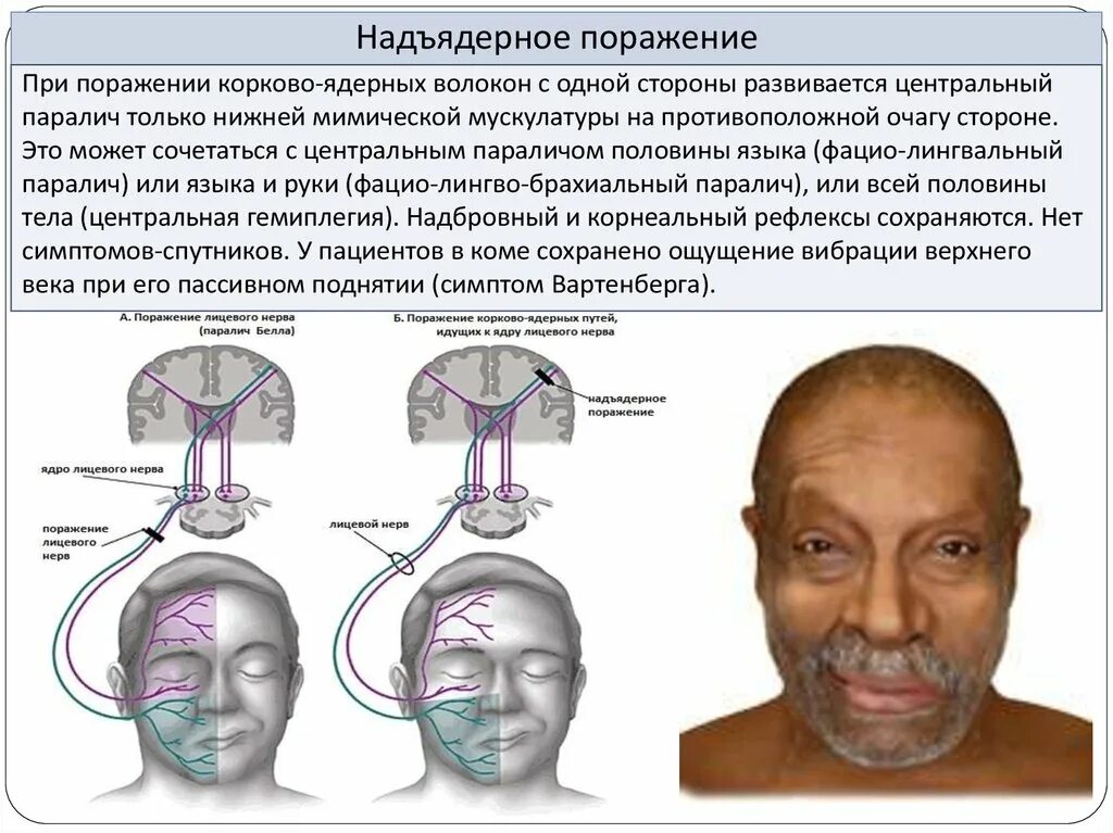 Порез лицевого. Паралич лицевого нерва симптомы неврология. Центральный и периферический парез лицевого нерва неврология. Порангие лицевого нерва. Паралич мимической мускулатуры.