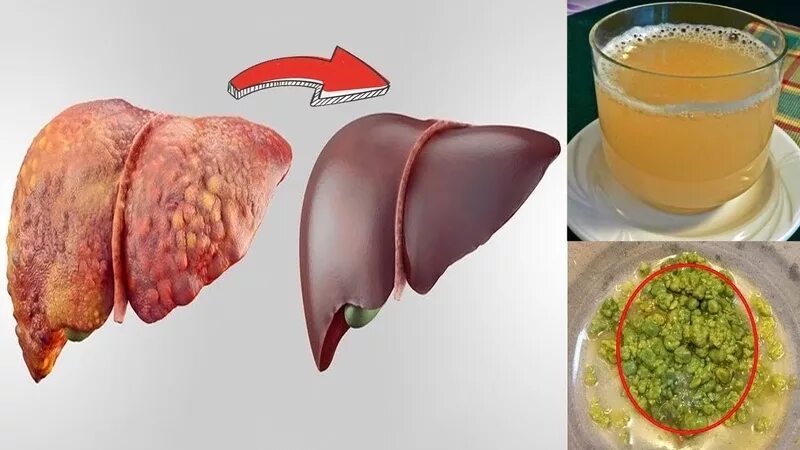 Прогревать печень