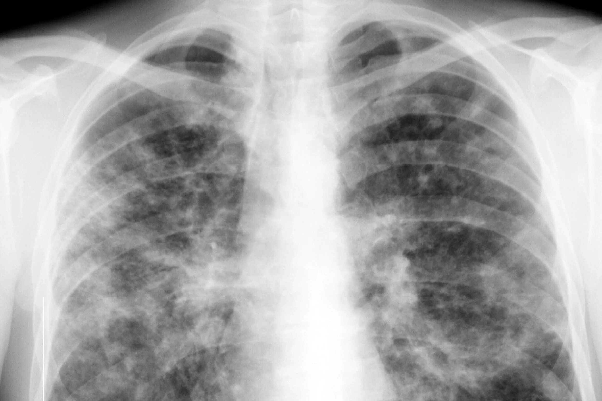 Рентгенологическая картина легочной чумы. Tuberkulyoza.