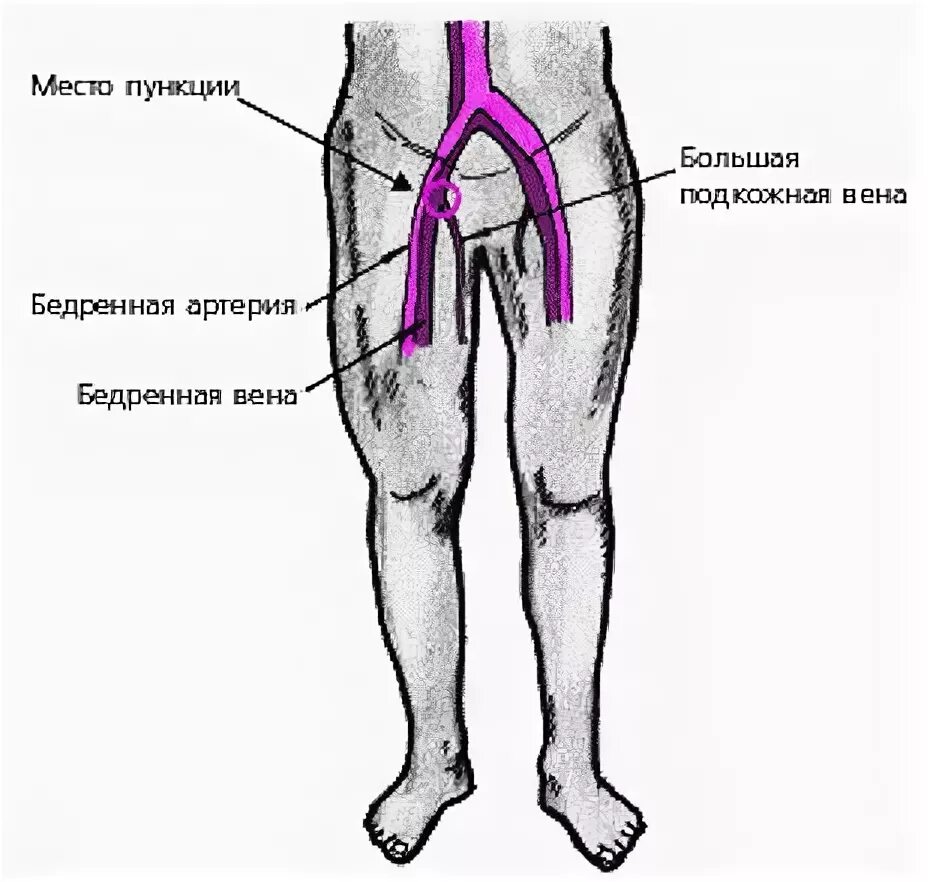 Вена в паху у мужчин. Пункция бедренной вены. Пункция бедренной артерии. Катетеризация бедренной артерии.