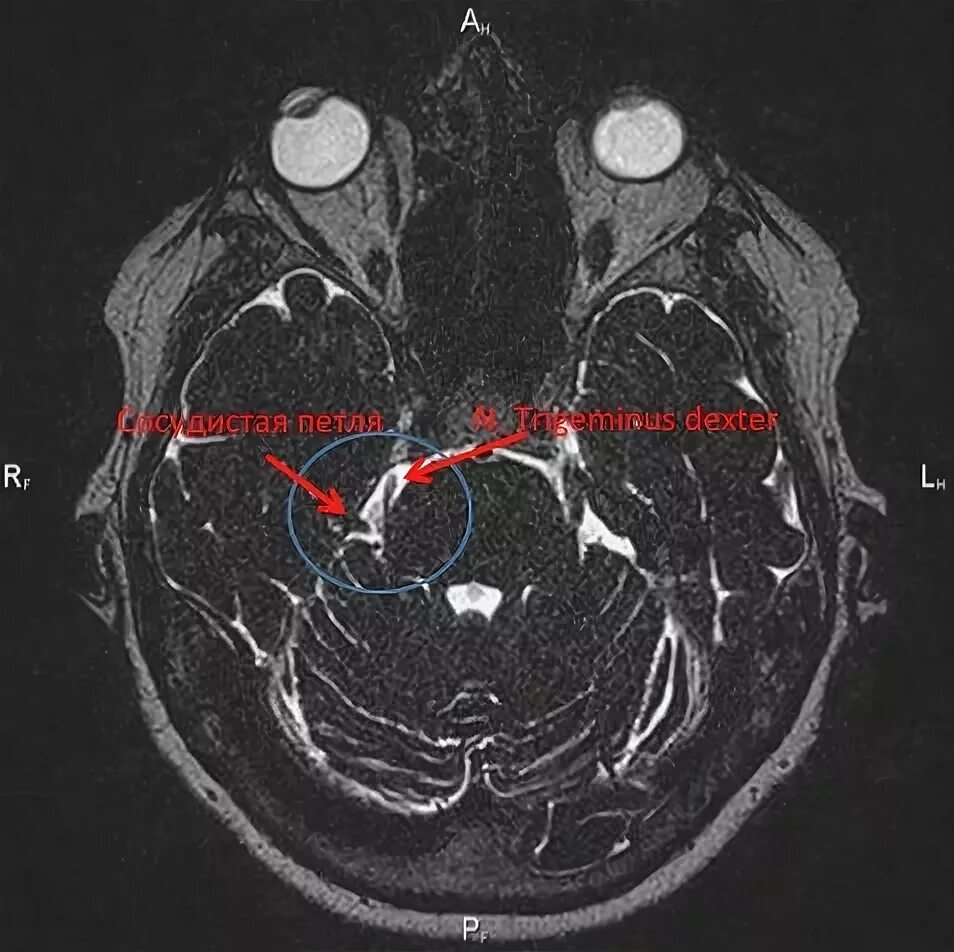 Мрт черепных нервов. Тройничный нерв мрт анатомия. Невралгия тройничного нерва нейроваскулярный конфликт. Вазоневральный конфликт мрт. Верхняя мозжечковая артерия мрт.