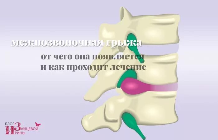 Межпозвонковая грыжа без операции. Лечение грыжи позвоночника без операции. Как вылечить грыжу без операции. Лечится ли грыжа позвоночника поясничного отдела без операции. Грыжа диска без операции Москва.