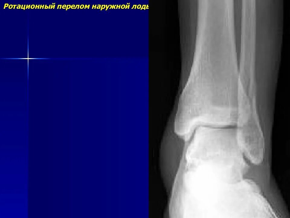 Трещина наружной. Апикальный перелом наружной лодыжки рентген. Перелом латеральной лодыжки рентген. Перелом эпифизеолиз наружной лодыжки. Апикальный перелом лодыжки.