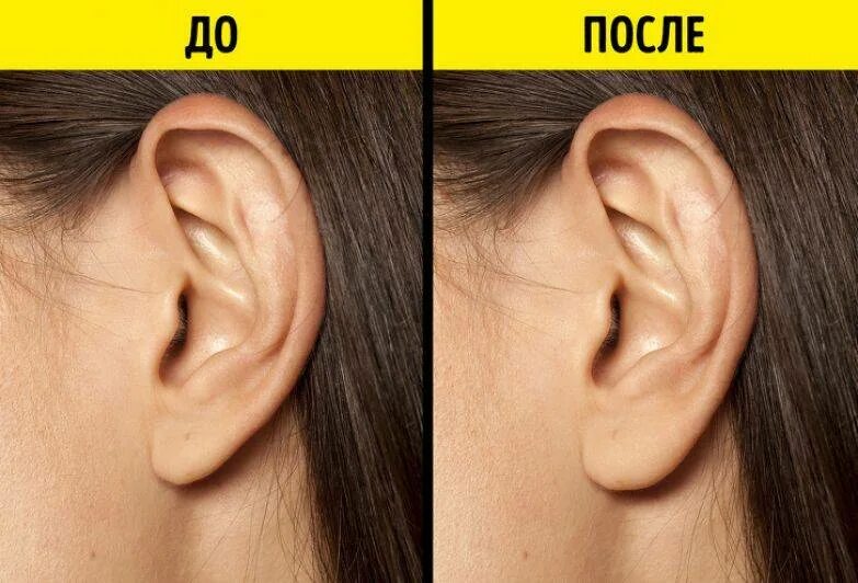 Как уменьшить уши. Как уменьшить уши