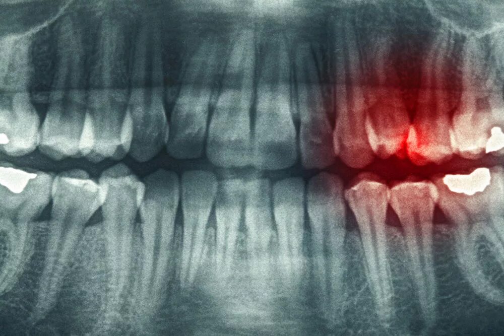 Снимок зубов видное. Киста зуба рентген снимок. Киста зуба на панорамном снимке.