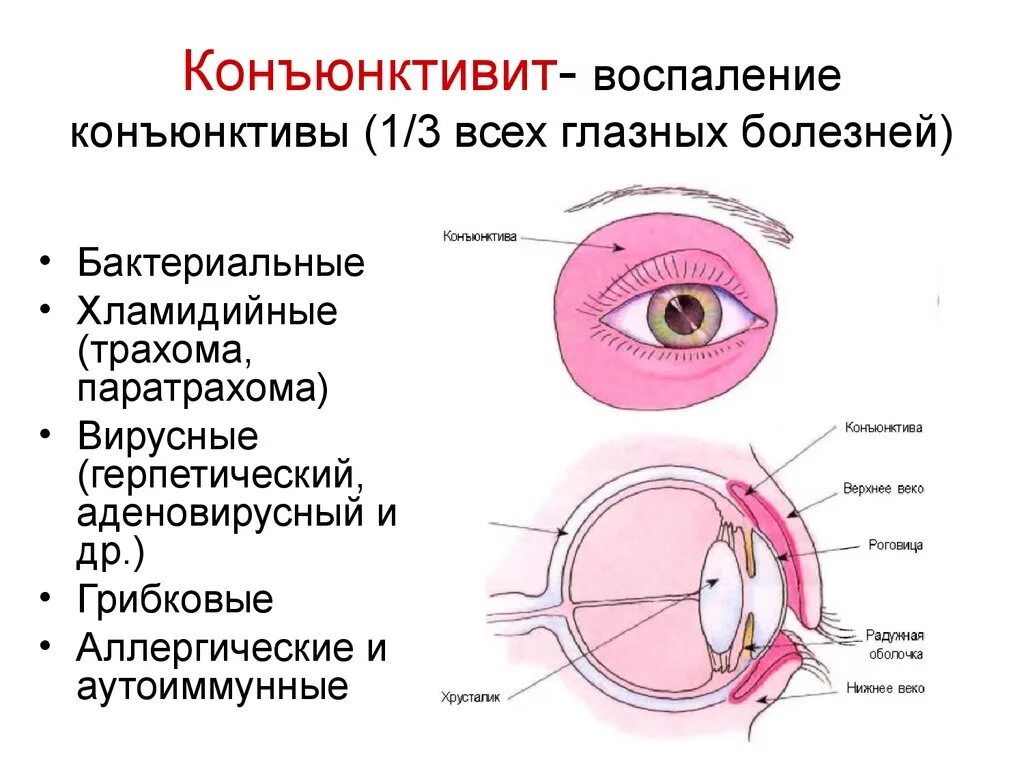 Конъюнктива ребенка. Конъюнктивит мешок конъюнктивальный мешок. Аденовирусная инфекция конъюнктивит. Хемоз – отек конъюнктивы глазного яблока.. Аденовирусный конъюнктивит роговица.