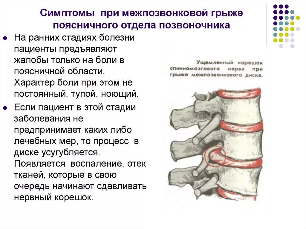 Симптомы позвоночного грыжи поясничного