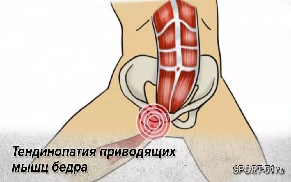 Тендиноз тазобедренного сустава что это такое. Сухожилия. Воспаление сухожилия четырехглавой мышцы бедра. Tendon of the semitendinosus (most prominent tendon). Тендинит приводящих мышц бедра.