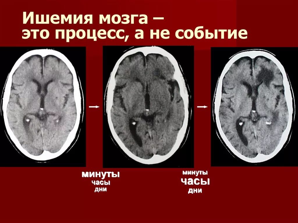 Что такое ишемический инсульт головного мозга. Ишемический инфаркт головного мозга кт. Острый ишемический инсульт мрт. Стадии ишемического инсульта на кт. Стадии ишемии головного мозга на кт.