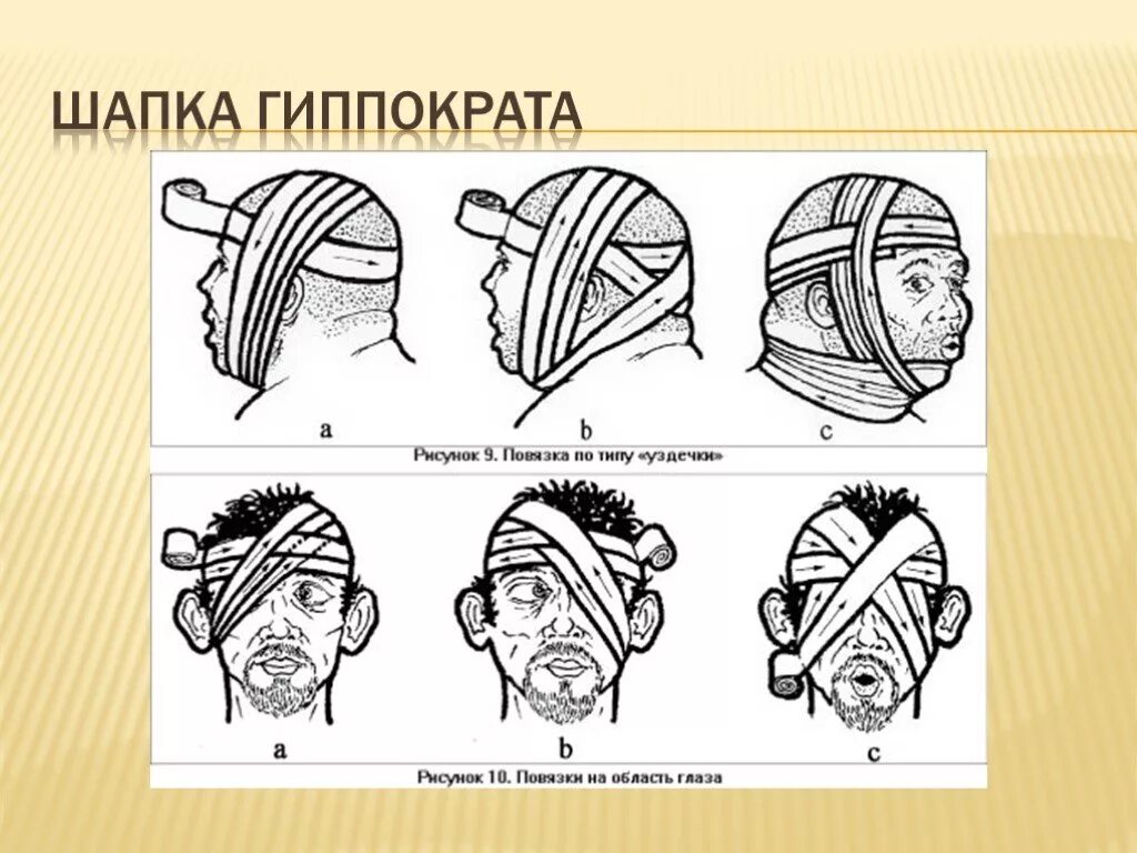 Повязка гиппократа техника наложения. Десмургия шапочка Гиппократа. Наложение повязки шапочка Гиппократа. Схема наложения повязки шапка Гиппократа. Чепец Гиппократа повязка.