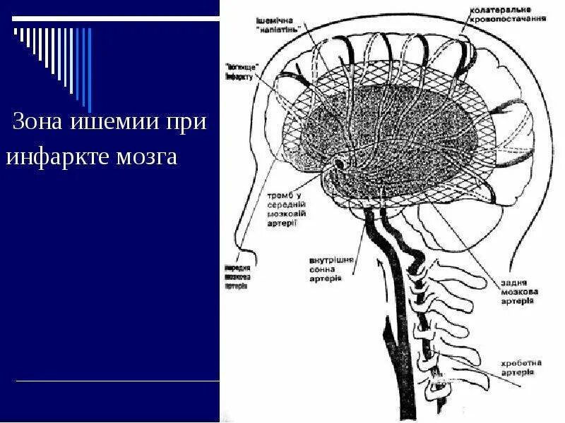 Зоны ишемии головного мозга. Зона ишемии