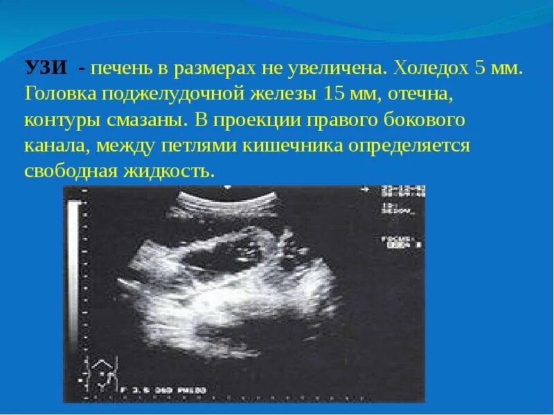 Свободная жидкость в брюшной полости на узи. Инвагинация кишечника у собаки узи. Спаечная непроходимость на узи. Узи кишок что это. Жидкость в брюшной полости на узи.