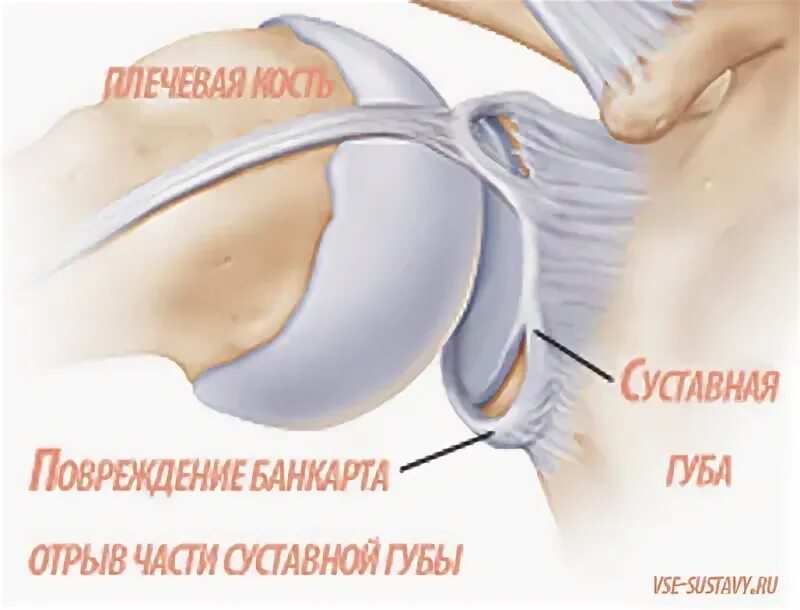 Изменение фиброзной губы гленоида. Изменение фиброзной губы гленоида