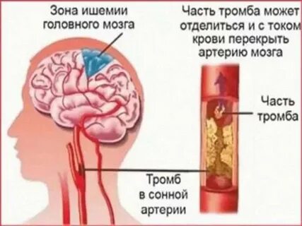 Ишемический инсульт артерий