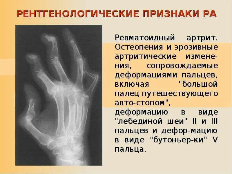Иммуновоспалительные заболевания. Неэрозивный артрит скв. Ревматоидный артрит кратко. Ревматоидный артрит кратко. Лихорадка при ревматоидном артрите.